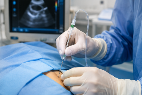 Top 5 Ultrasound Nerve Block Needles for 2026